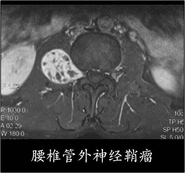 椎管神经鞘瘤是什么?