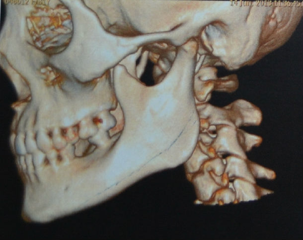下颌角肥大的不同的截骨手术方式