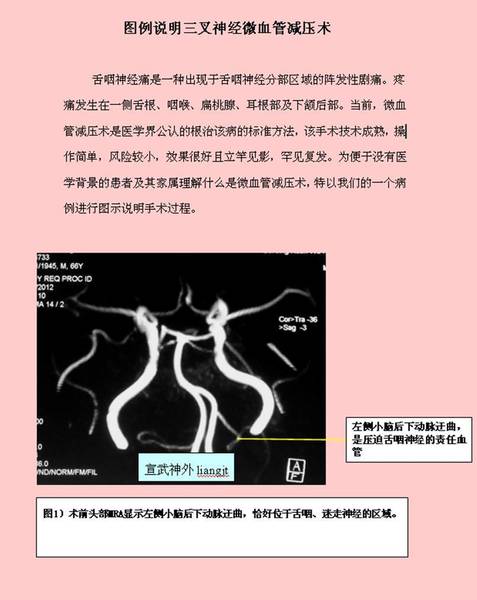 图例说明微血管减压术治疗舌咽神经痛_梁建涛