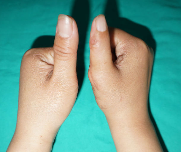 先天性拇指多指畸形复拇指畸形的矫正