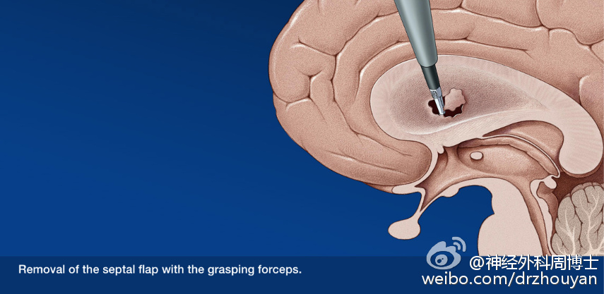 脑积水手术费图片
