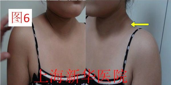 翼状肩胛(副神经损伤)典型病例是怎样的?