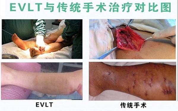 下肢静脉曲张应该如何治疗好