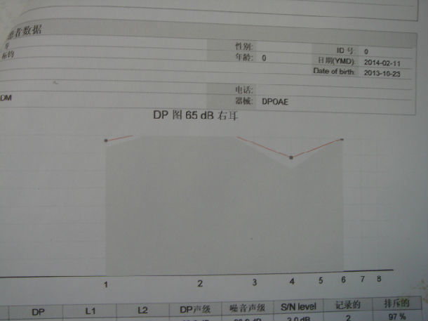 85db,,声导抗测试示双耳鼓室曲线为a型,镫骨肌反射未引出
