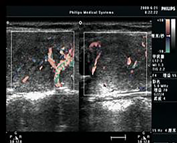 甲狀腺炎超聲表現(xiàn)圖片