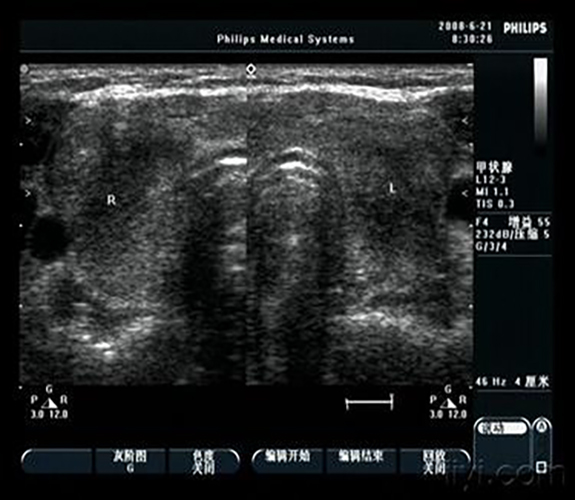 甲狀腺炎b超表現(xiàn)圖片