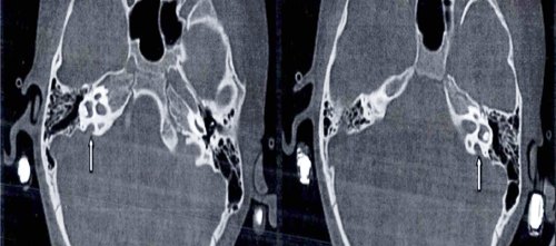 大前庭导水管综合征的CT影像学诊断_吴佩娜