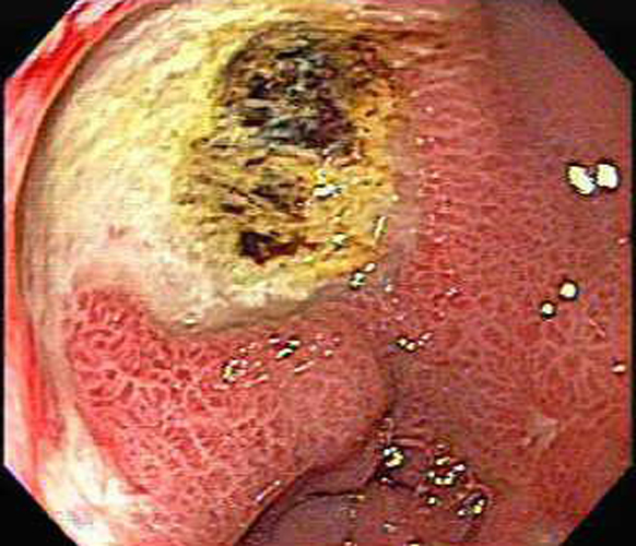 重度多片糜烂性胃炎图片