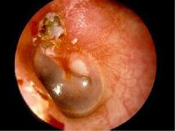 中耳炎介绍_中耳炎病因_中耳炎治疗_中耳炎医院医生