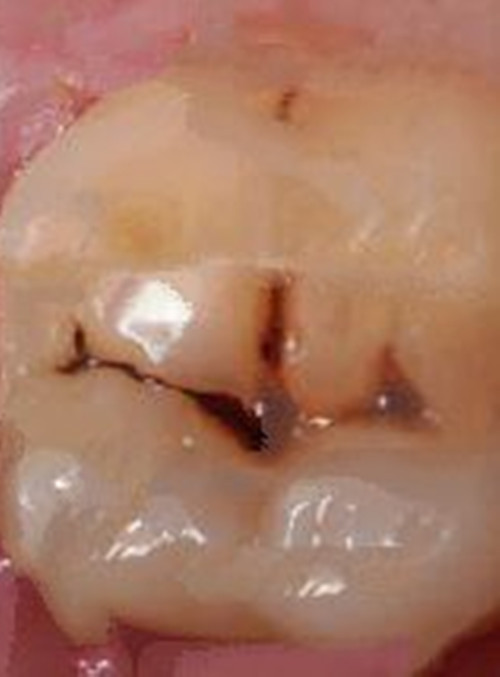 慢性牙髓炎的图片