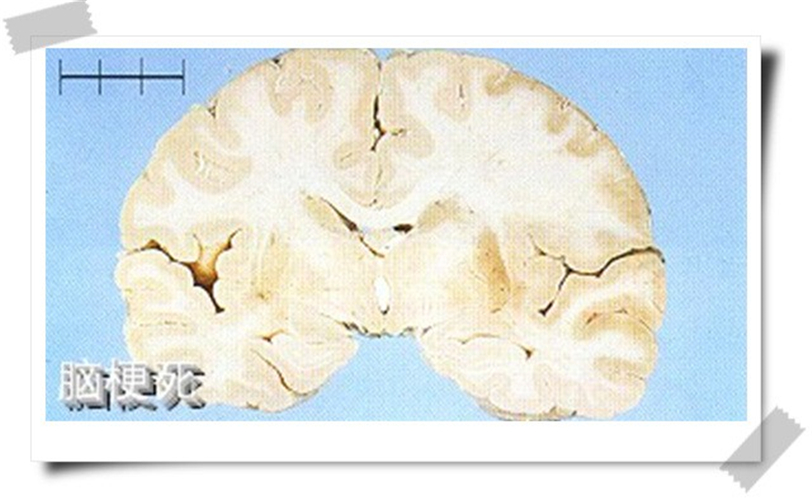 腦梗塞的腦部圖片