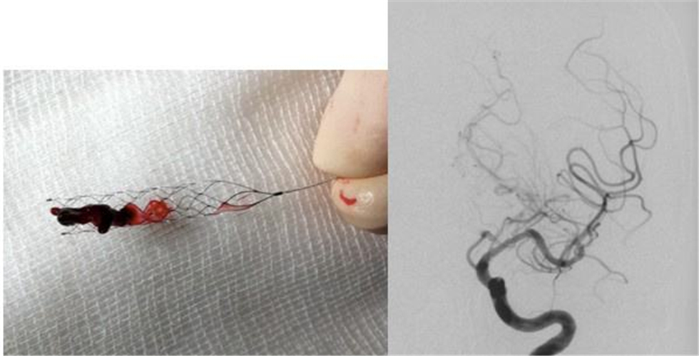 腦梗塞血管取出物圖片