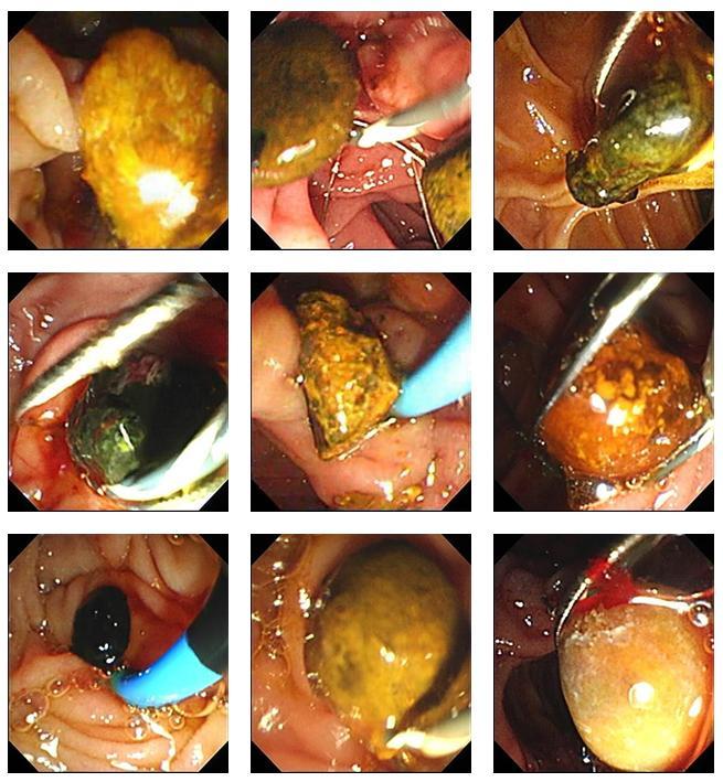 十二指肠镜下取石后结石百态