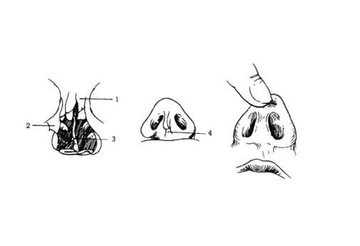 鼻中隔或鼻腔内软骨暴露的鉴别诊断