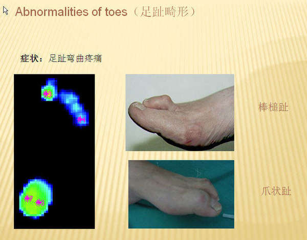 锤状趾怎么办