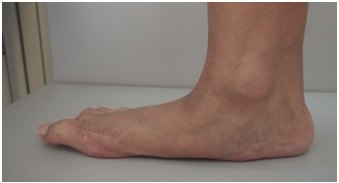 足踝的常见疾病包括很多,主要包括以下几大类:   1,足踝部畸形:拇外翻