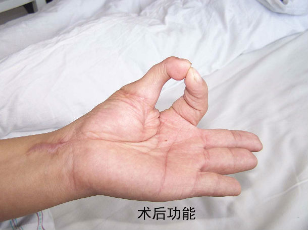 第2足趾游离移植再造拇指术