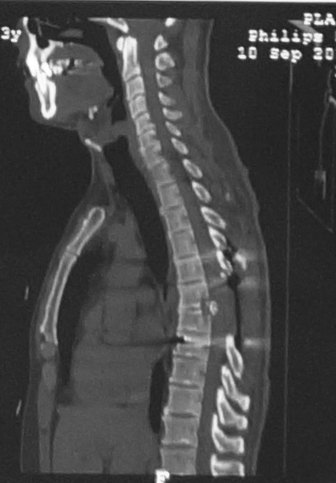 术后x线片示胸椎6,7椎间隙后部相邻终板和椎体切除