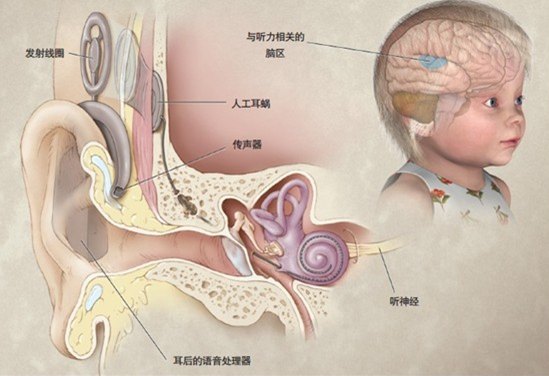 人工耳蜗是如何帮患者恢复听力的?