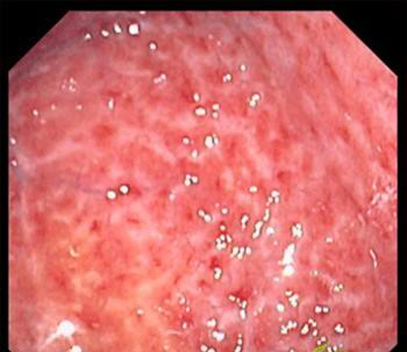 重度多片糜烂性胃炎图片
