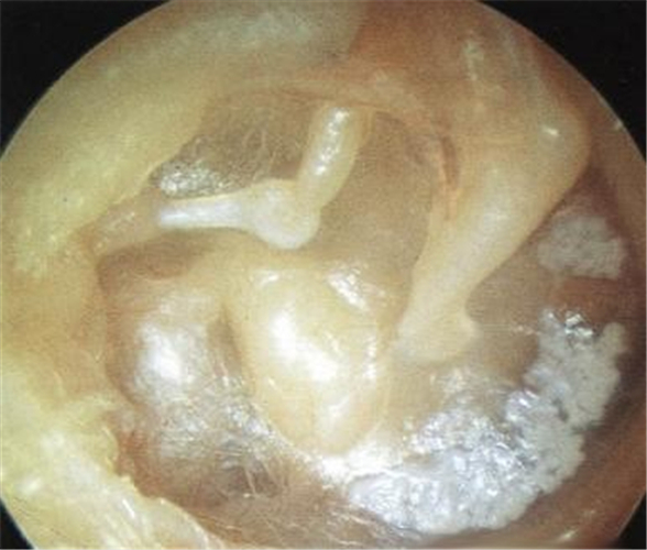 中耳炎介绍_中耳炎病因_中耳炎治疗_中耳炎医院医生_有来医生