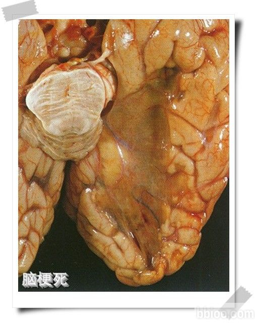 腦梗塞大腦圖片