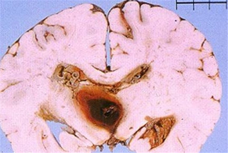 出血性腦梗塞切片圖片