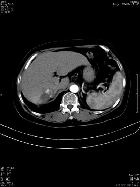 原右肝肿瘤区域未见强化,且明显缩小