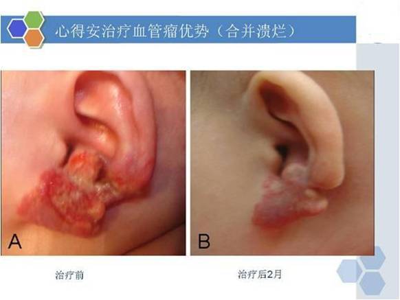 治疗目的:使血管瘤体不在生长或者消失