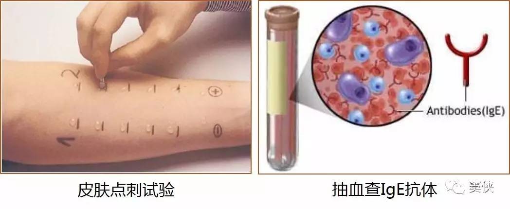 仔细进行体格检查;   进行牛奶过敏原检查:可以做皮肤点刺试验