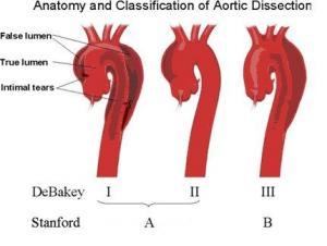 什么是主动脉夹层?