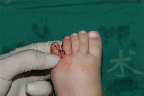 先天性多趾并趾畸形的治疗