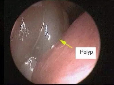 图2 鼻息肉
