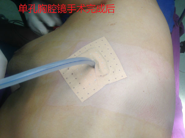 单孔胸腔镜手术是什么?