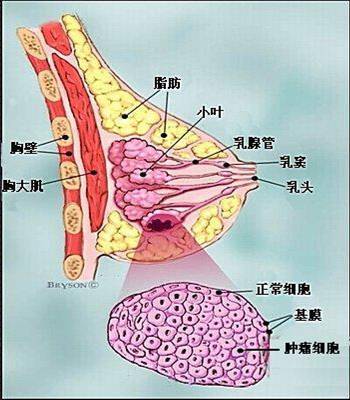 乳腺癌的发病机理尚不明确.