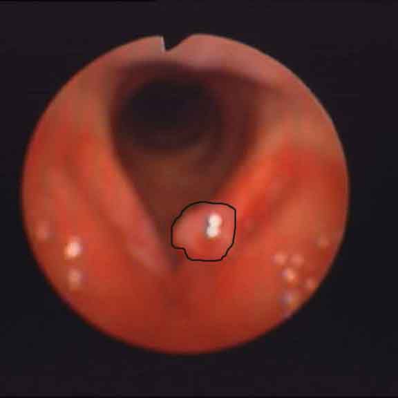 什么是视频喉镜下声带息肉切除术?