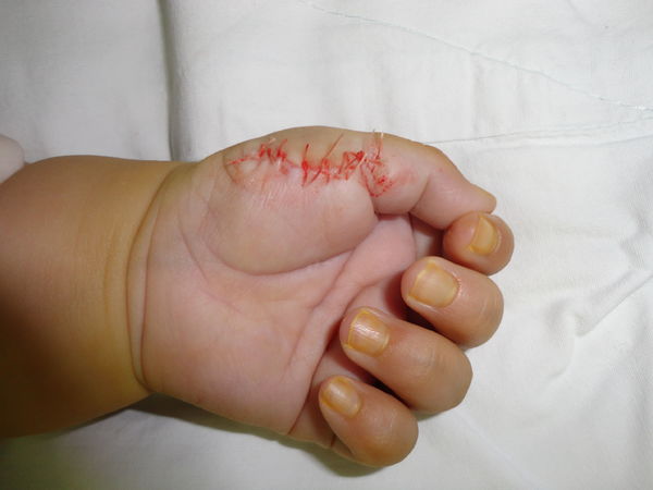 小婴儿多指切除术全过程