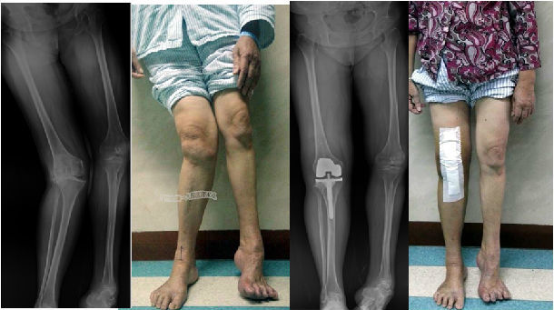 膝关节骨性关节炎并严重外翻畸形术后完全矫正