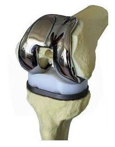 TKA――全膝关节置换术介绍