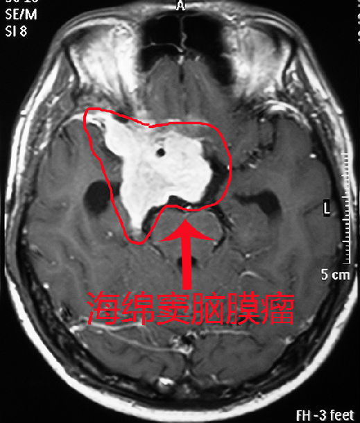 右侧翼点开颅海绵窦脑膜瘤切除是怎样的?