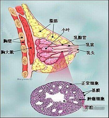 乳腺原位癌.