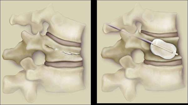 传统的非球囊扩张椎体成形术不用球囊扩张直接将骨水泥注入压缩的椎体