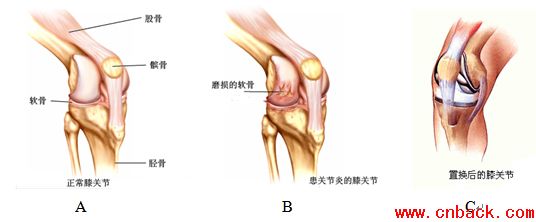[图解]人工膝关节置换手术全过程
