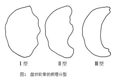 盘状半月板如何诊治?