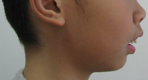 鼻炎或腺样体肥大等原因造成鼻呼吸不畅,引起开唇露齿,上腭高拱脸变窄