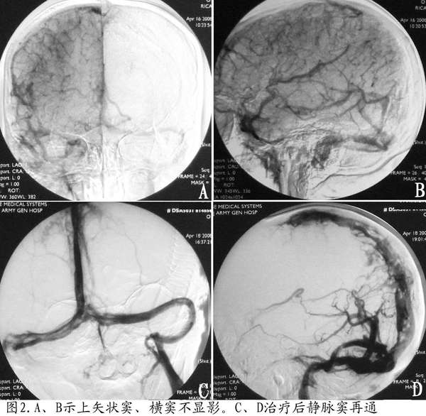 产后颅内静脉窦血栓形成介入治疗