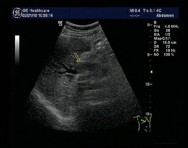 原发性肝癌合并胆管癌栓的诊断和外科治疗_周