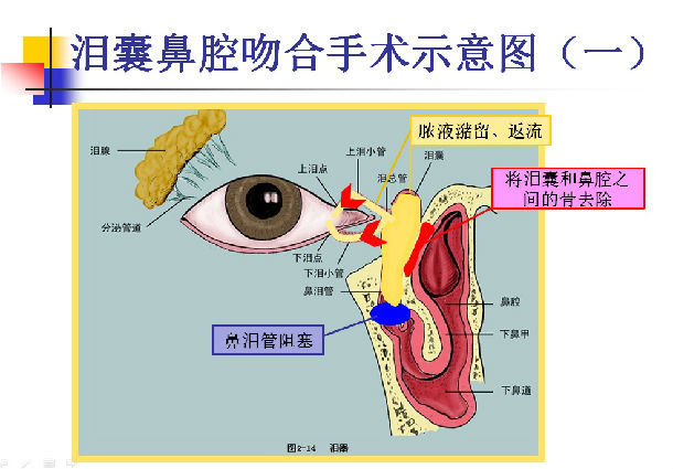 泪囊鼻腔吻合手术的"内路"和"外路"