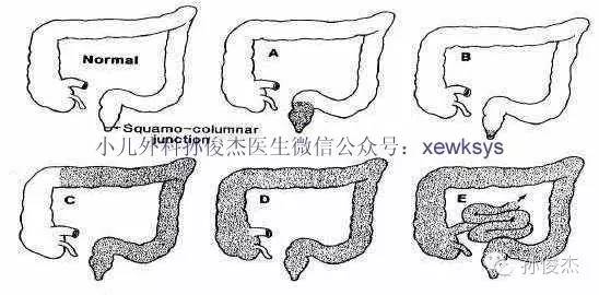 先天性巨结肠及其类缘病,知其然,知其所以然