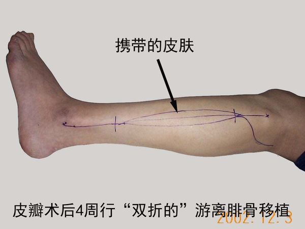 胫后动脉踝上皮支皮瓣与双折的游离腓骨移植治疗小腿下段骨缺.